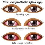 Pink Eye 2
