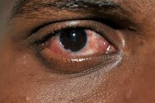 Pink Eye